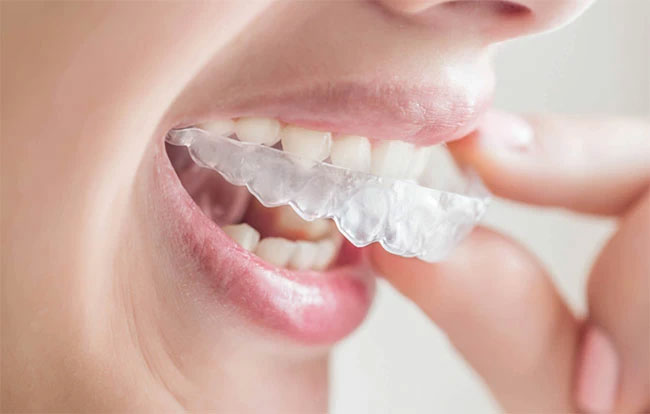 invisalign-model-1